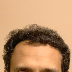 Fue Hair Transplant 03