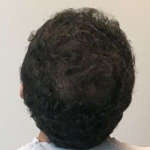 Fue Hair Transplant 07