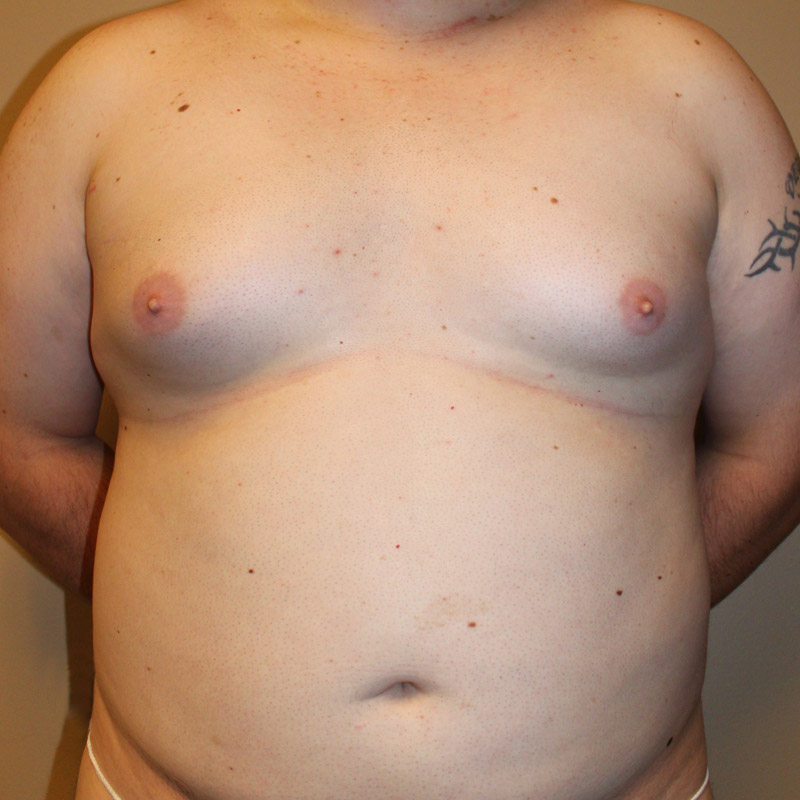 Gynecomastia 01