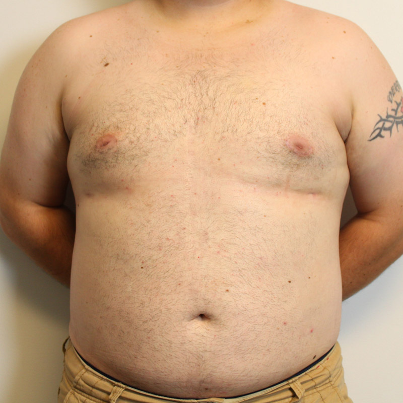 Gynecomastia 01