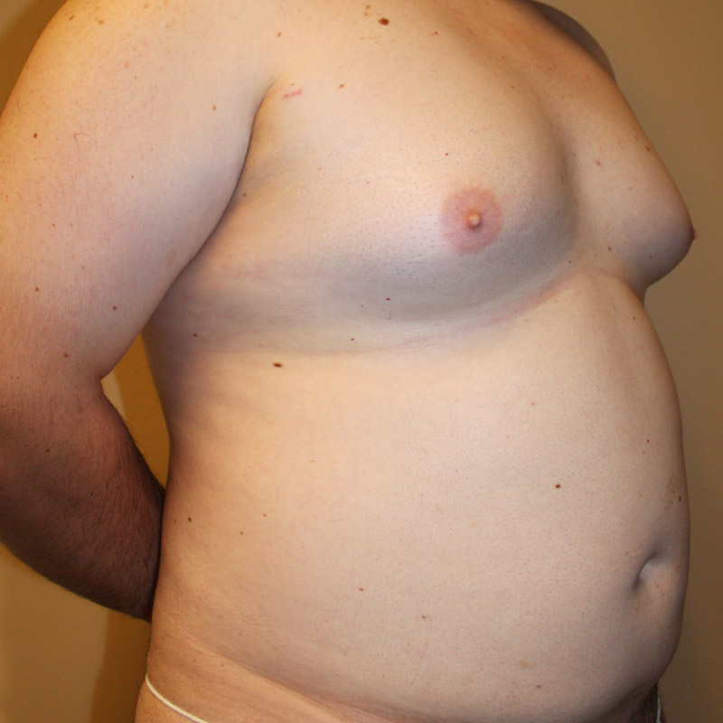 Gynecomastia 05