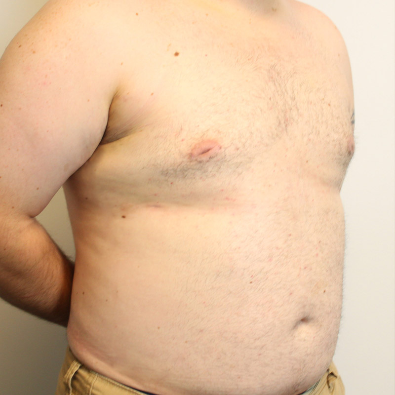 Gynecomastia 05