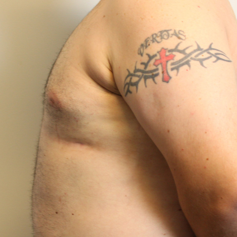 Gynecomastia 09