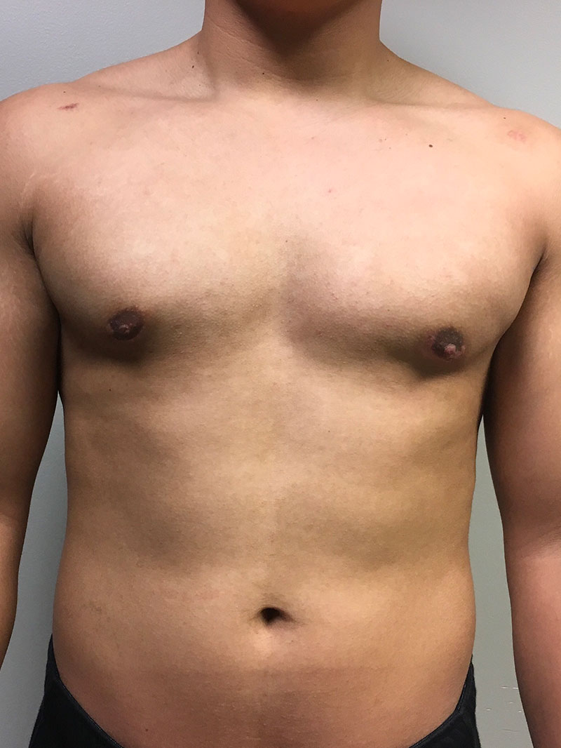 Gynecomastia 03