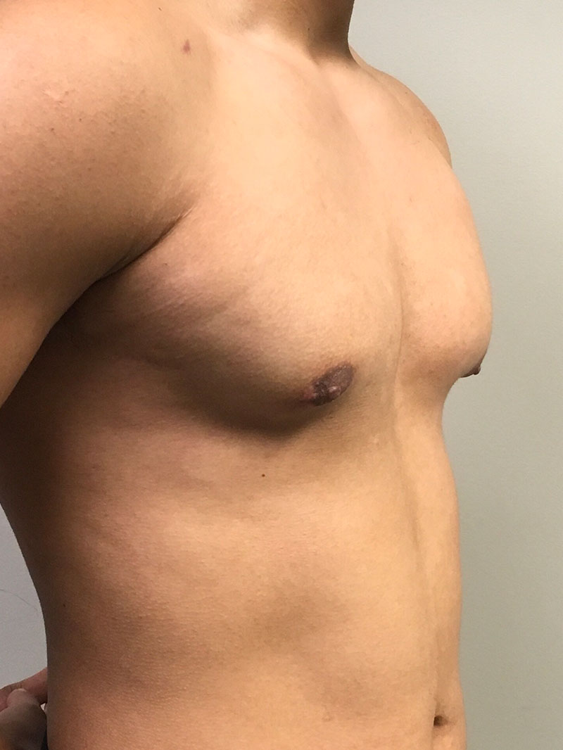 Gynecomastia 05
