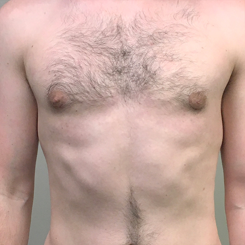 Gynecomastia 04