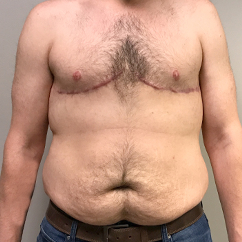 Gynecomastia 06