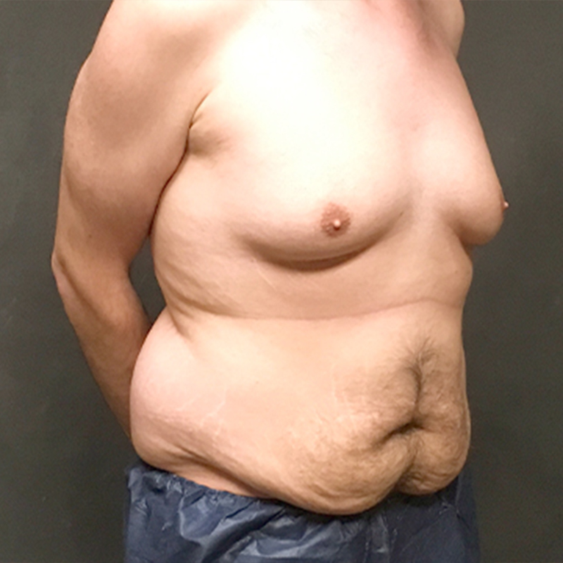 Gynecomastia 03