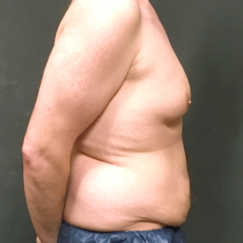 Gynecomastia 05