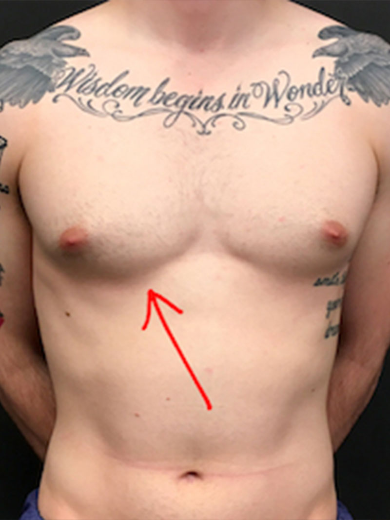 Gynecomastia 01