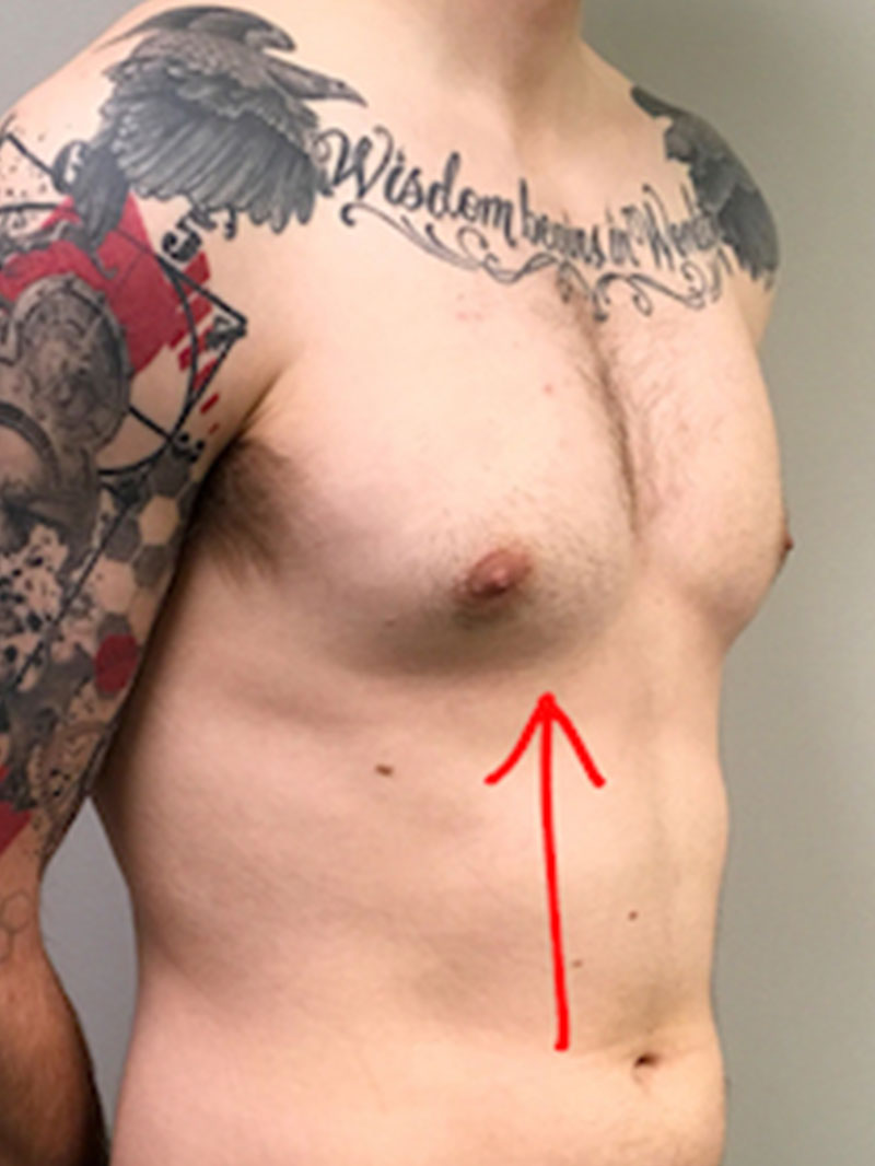 Gynecomastia 03