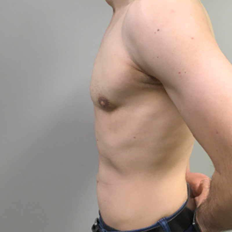 Gynecomastia 03