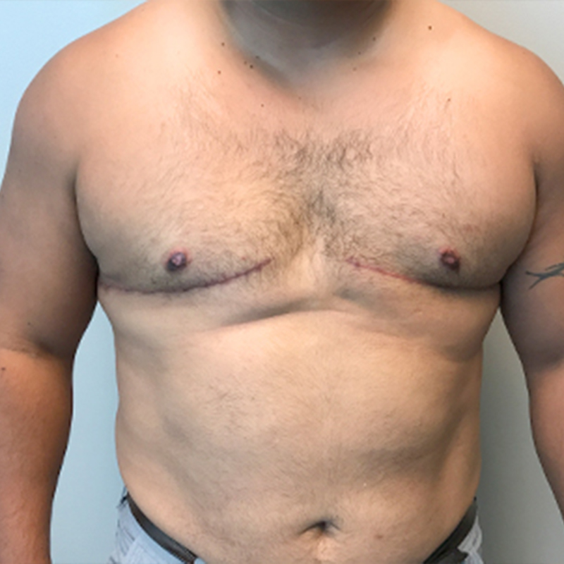 Gynecomastia 09