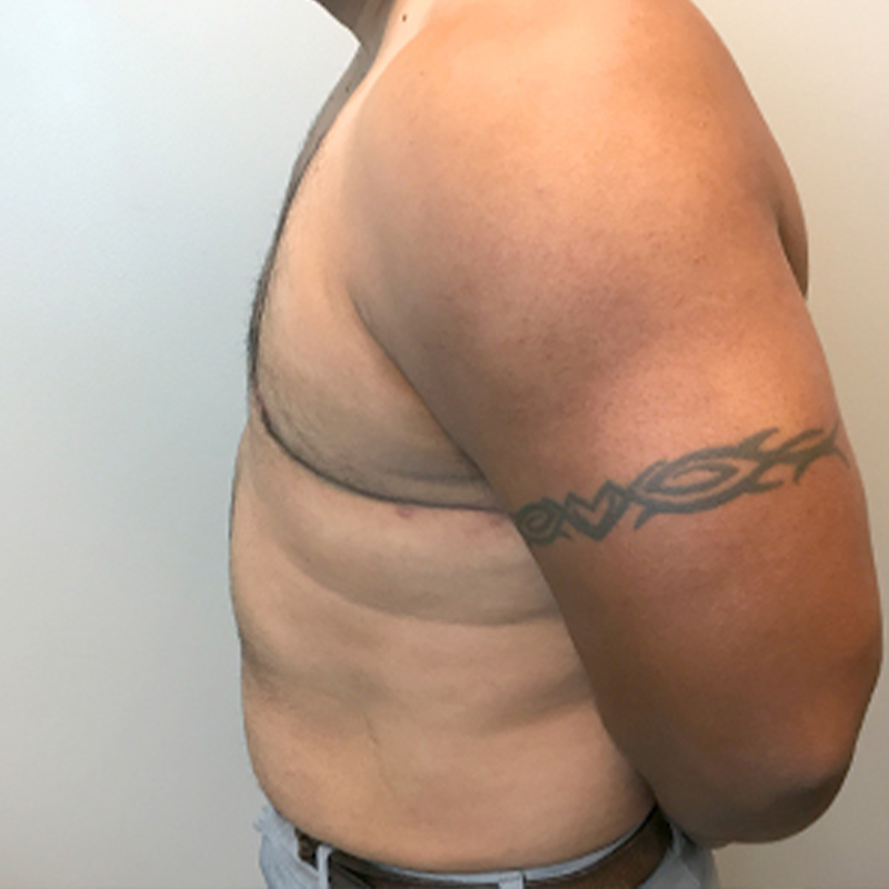 Gynecomastia 05