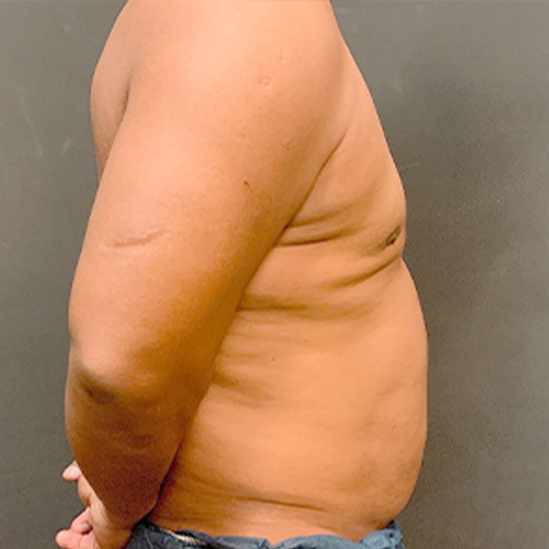 Gynecomastia 09
