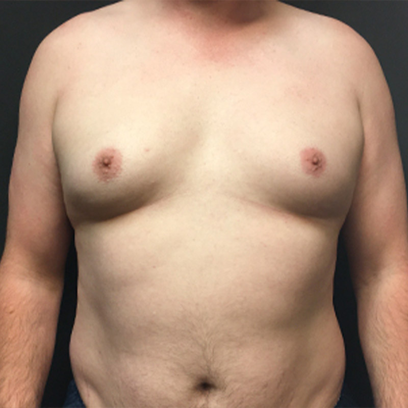 Gynecomastia 01