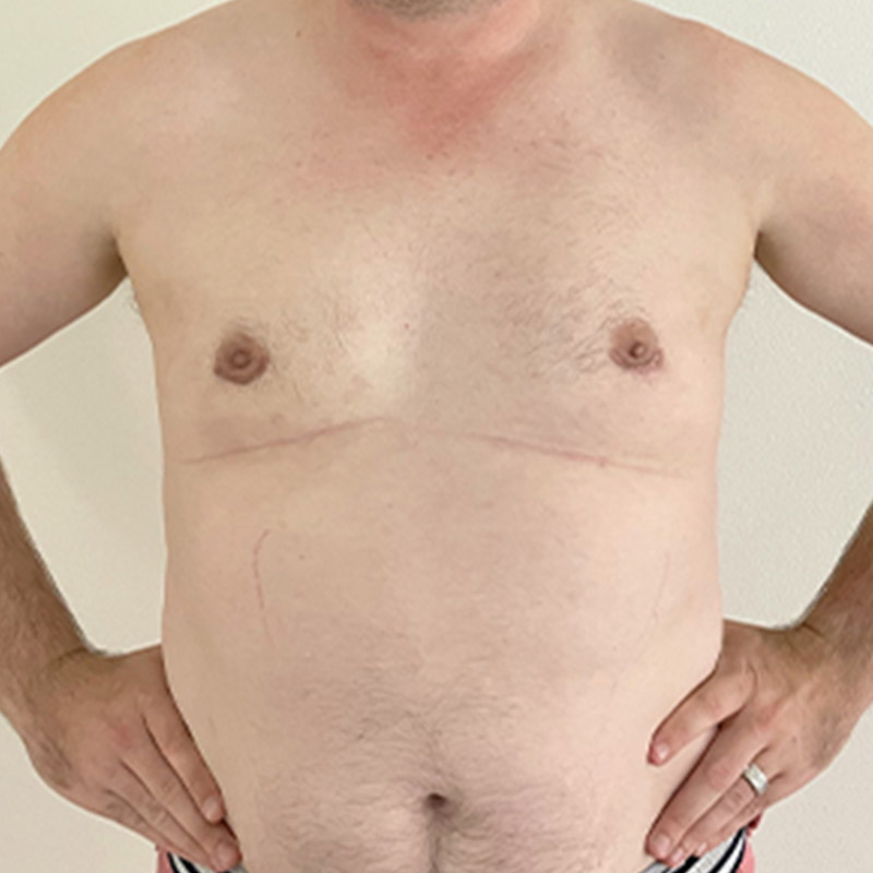 Gynecomastia 10