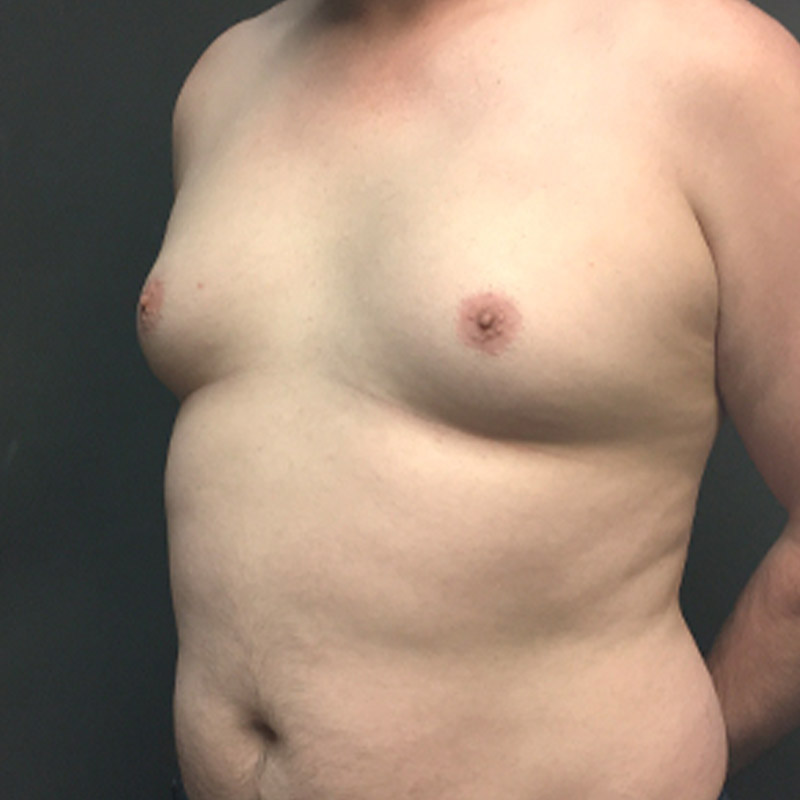 Gynecomastia 03