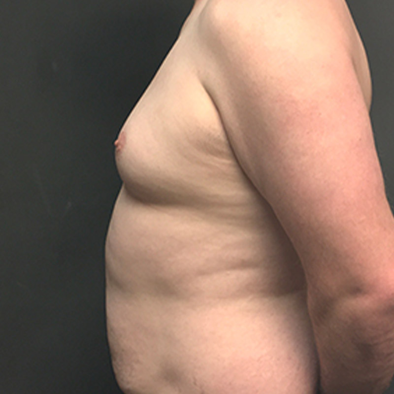 Gynecomastia 05