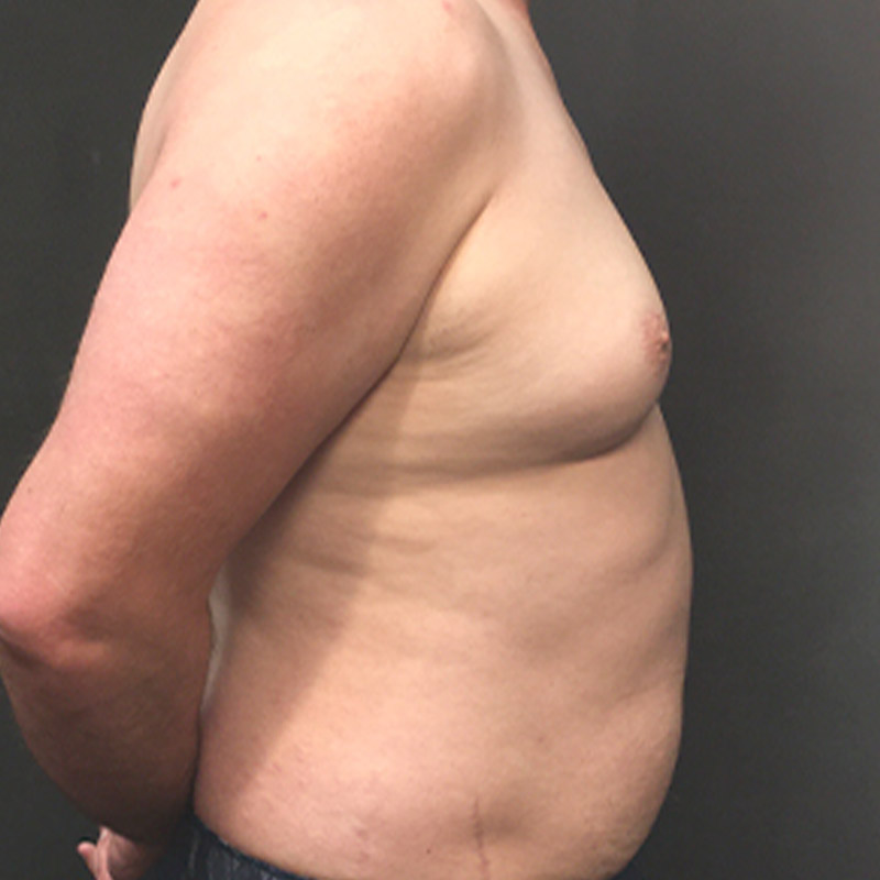 Gynecomastia 09