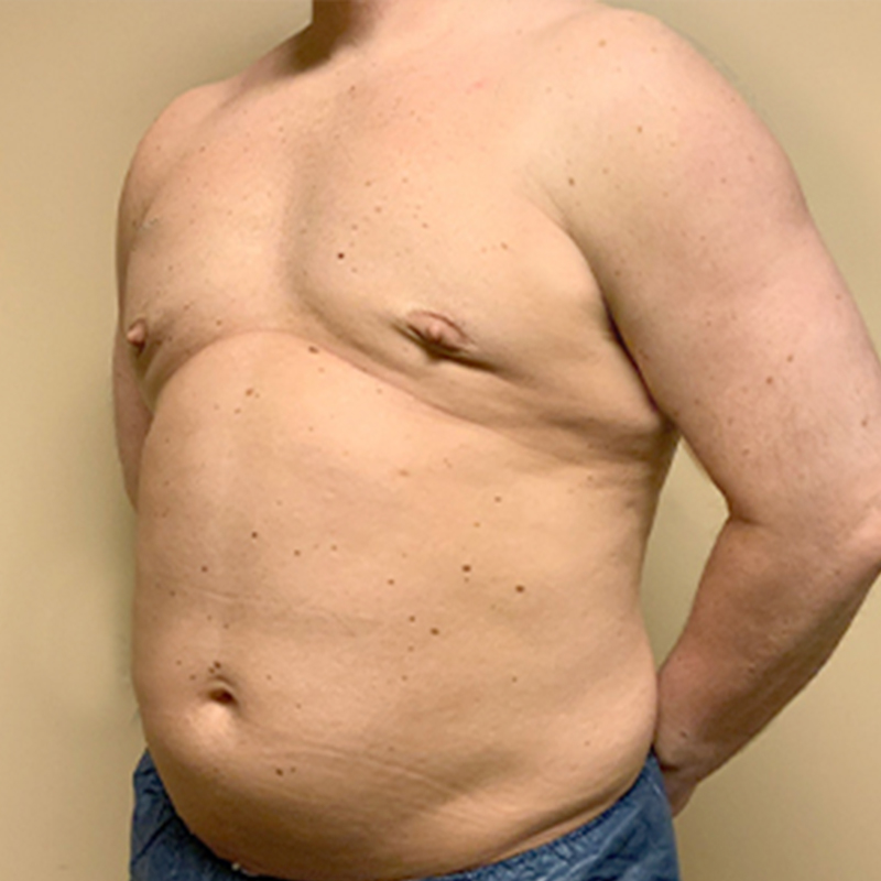 Gynecomastia 03