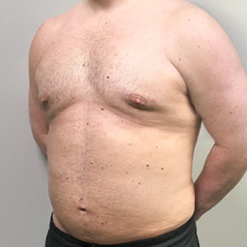 Gynecomastia 03