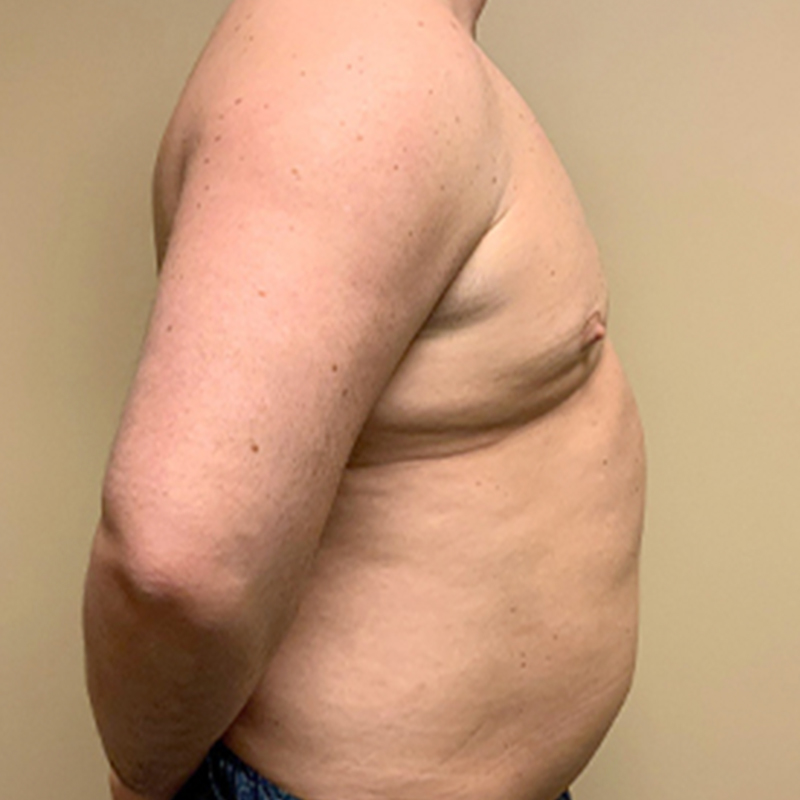 Gynecomastia 11