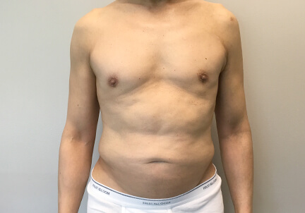 Gynecomastia 12