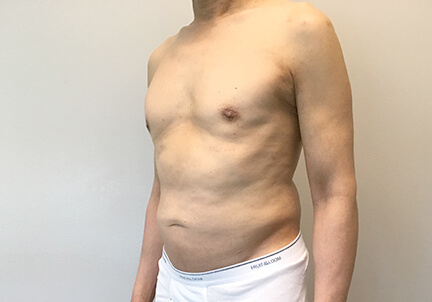 Gynecomastia 03