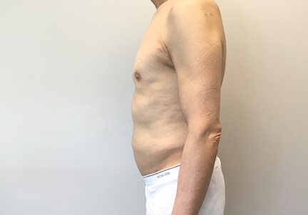 Gynecomastia 05