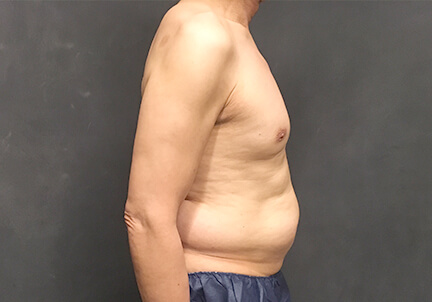 Gynecomastia 07