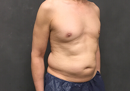 Gynecomastia 09