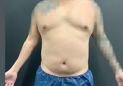 Gynecomastia 01