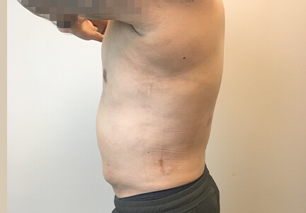Gynecomastia 03
