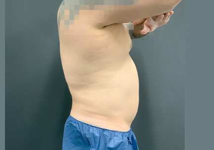 Gynecomastia 05