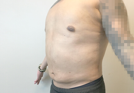 Gynecomastia 07