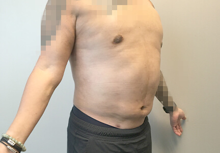 Gynecomastia 09