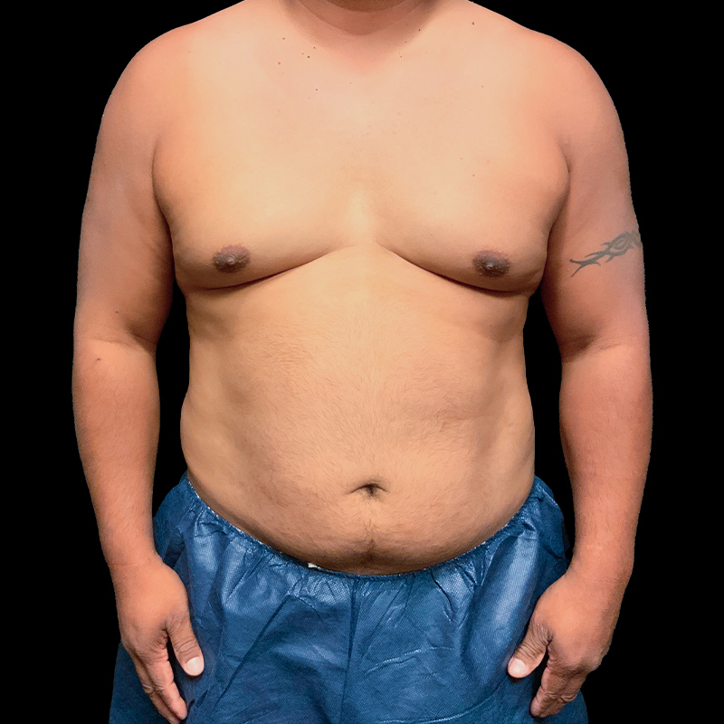 Gynecomastia 01
