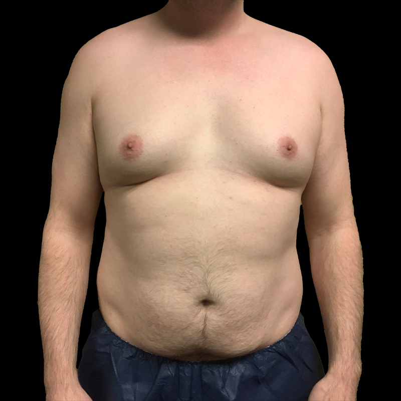 Gynecomastia 01
