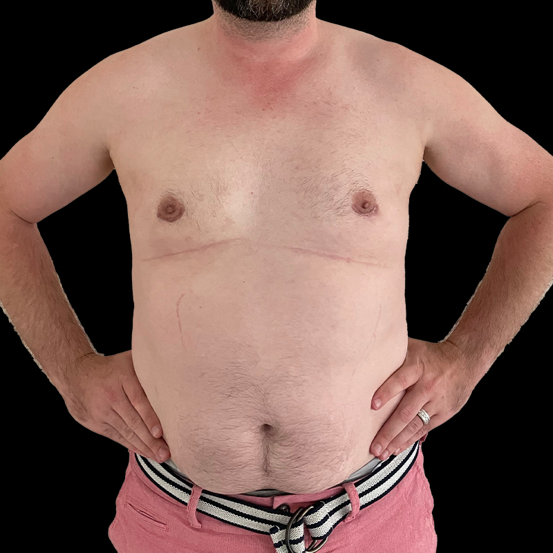 Gynecomastia 15