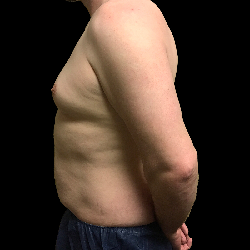 Gynecomastia 03