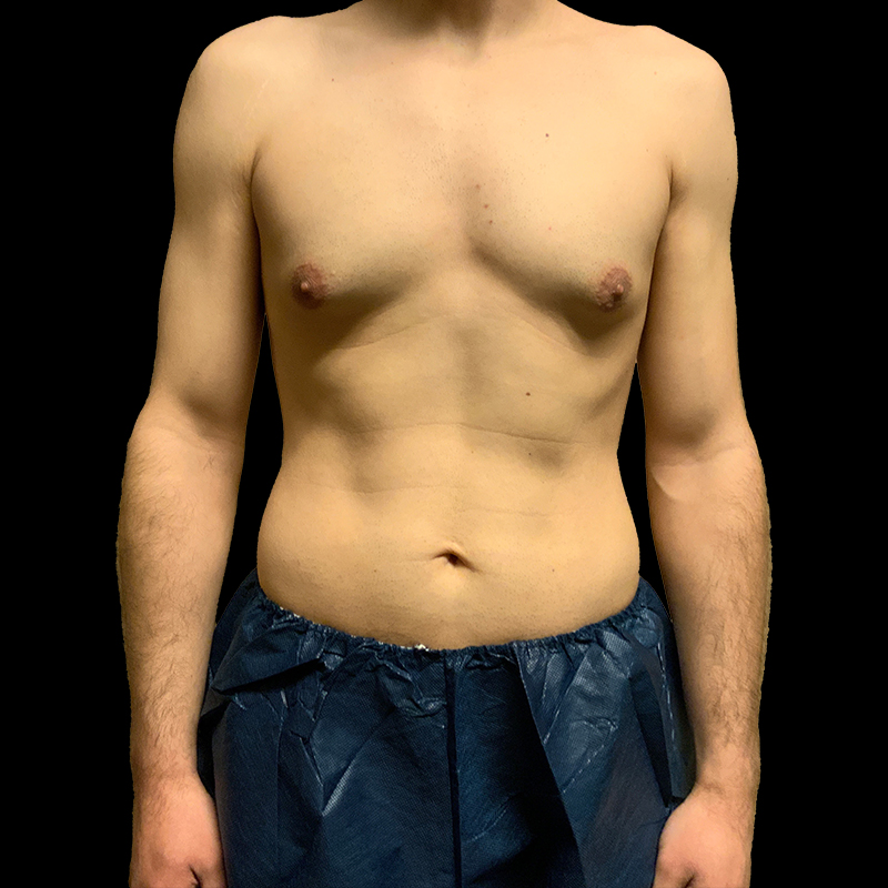 Gynecomastia 01