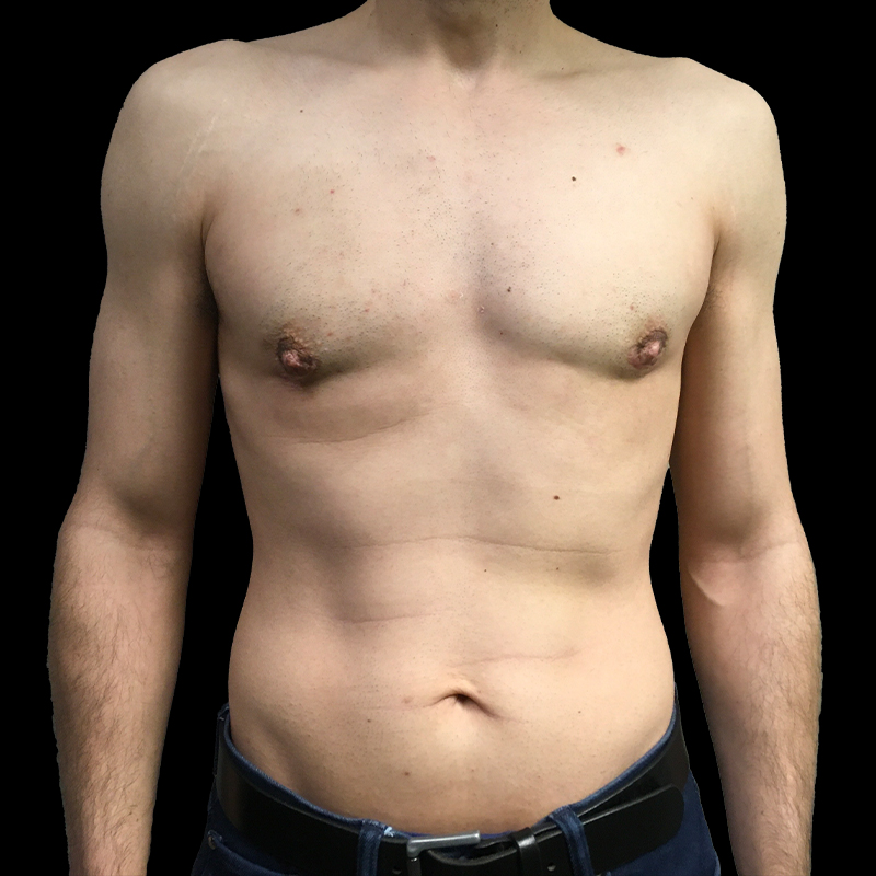 Gynecomastia 16