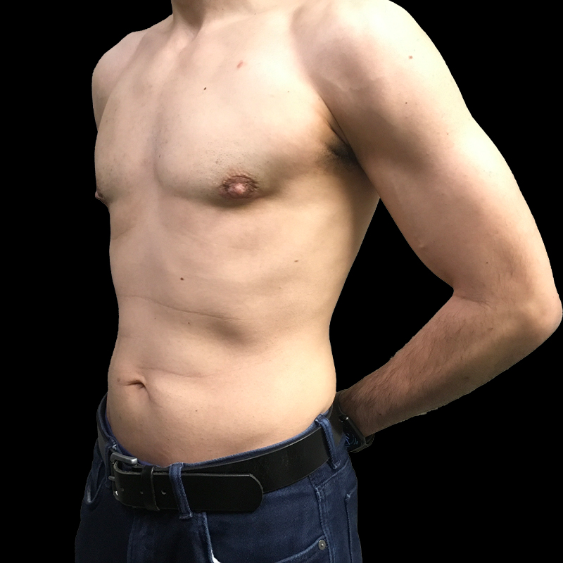 Gynecomastia 05