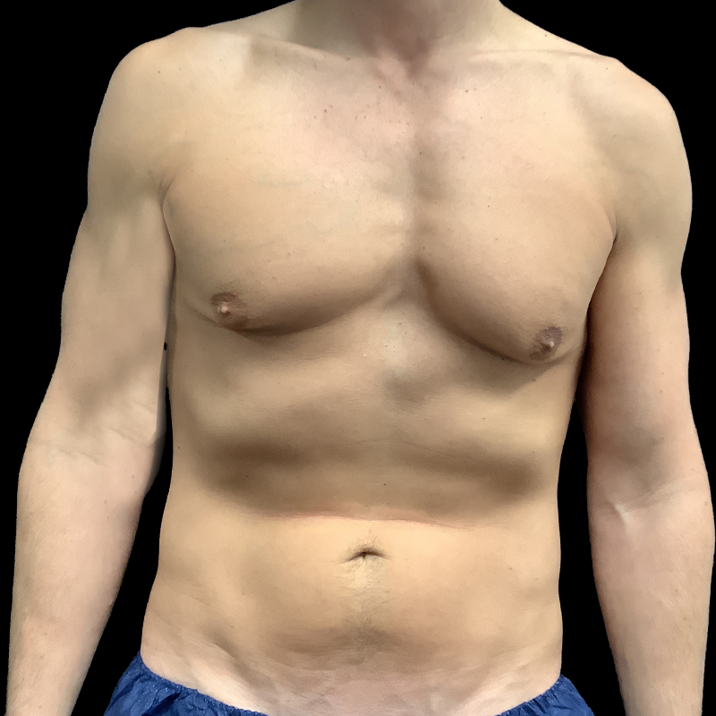 Gynecomastia 01
