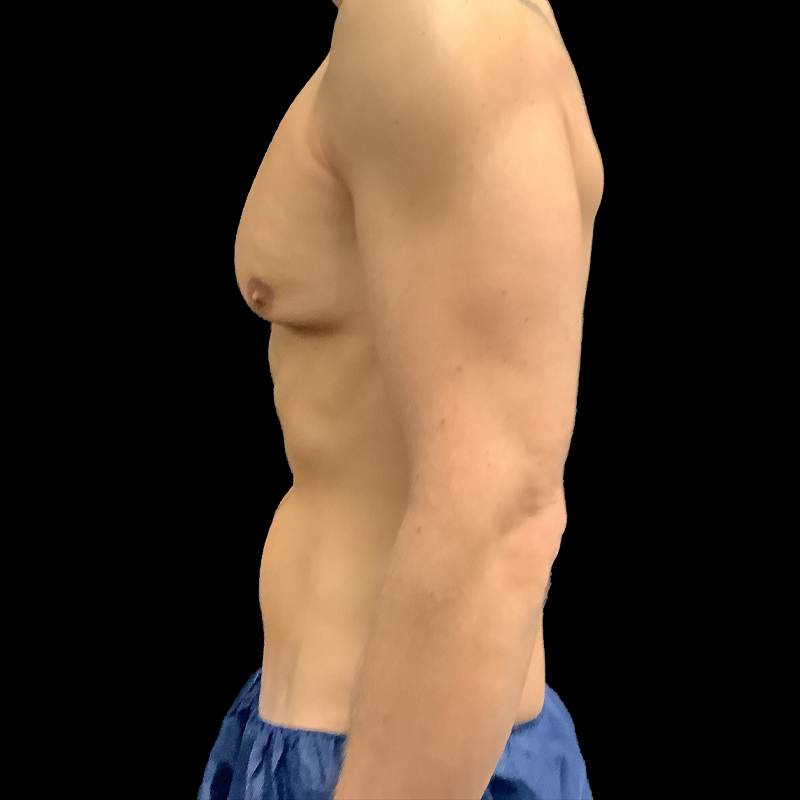 Gynecomastia 03