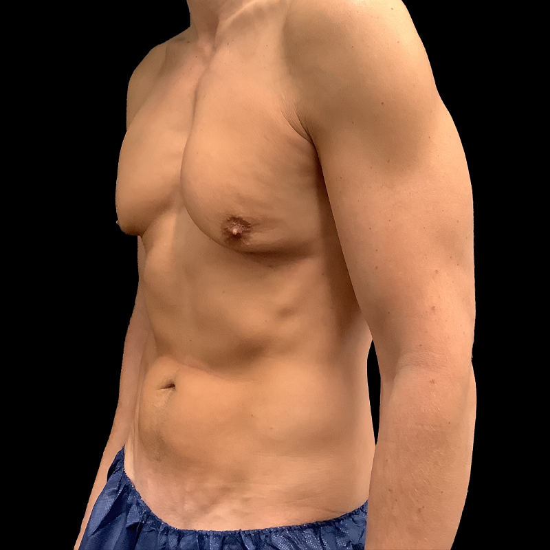 Gynecomastia 05