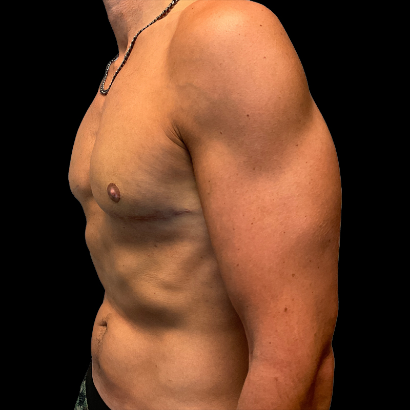 Gynecomastia 05