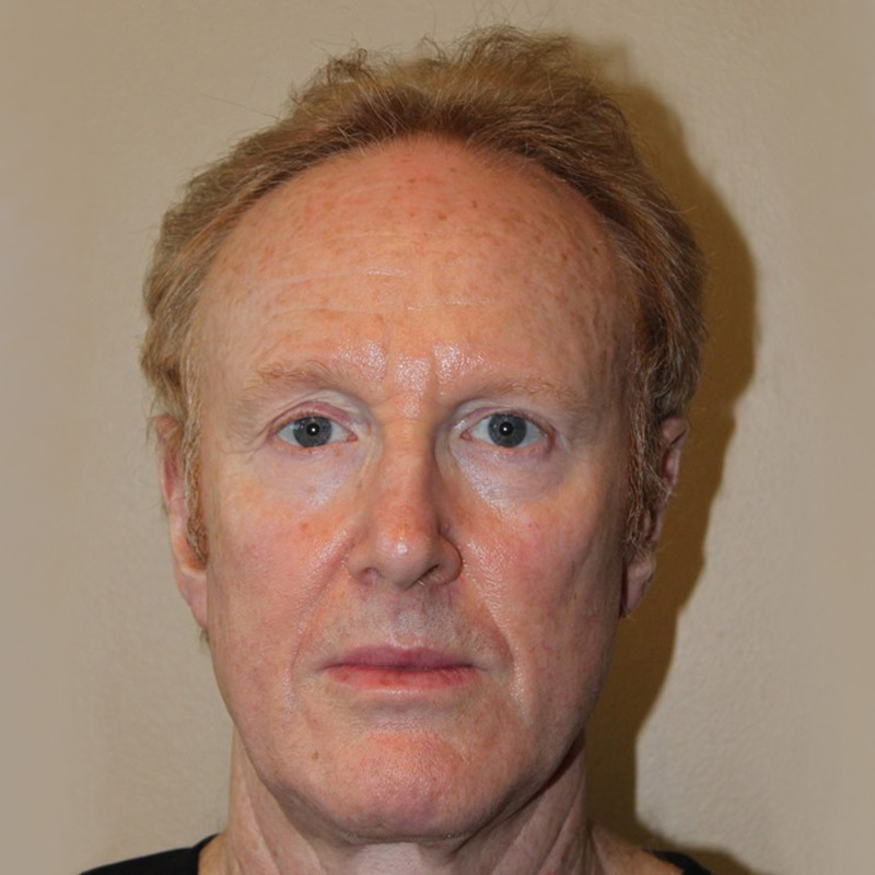 Hair Restoration Removed Photos Deletable 01