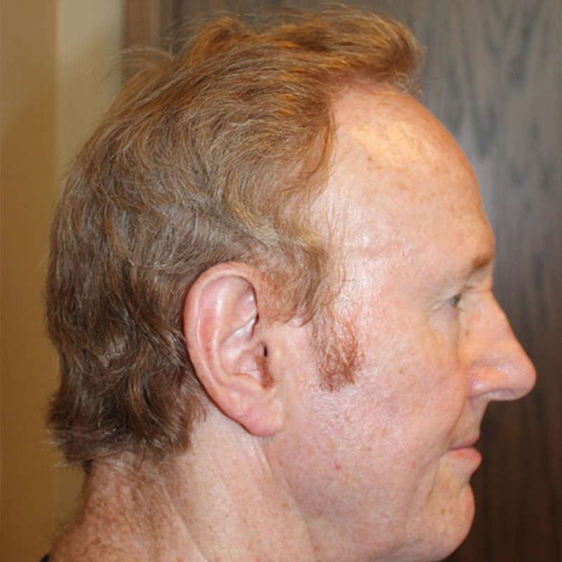 Hair Restoration Removed Photos Deletable 03